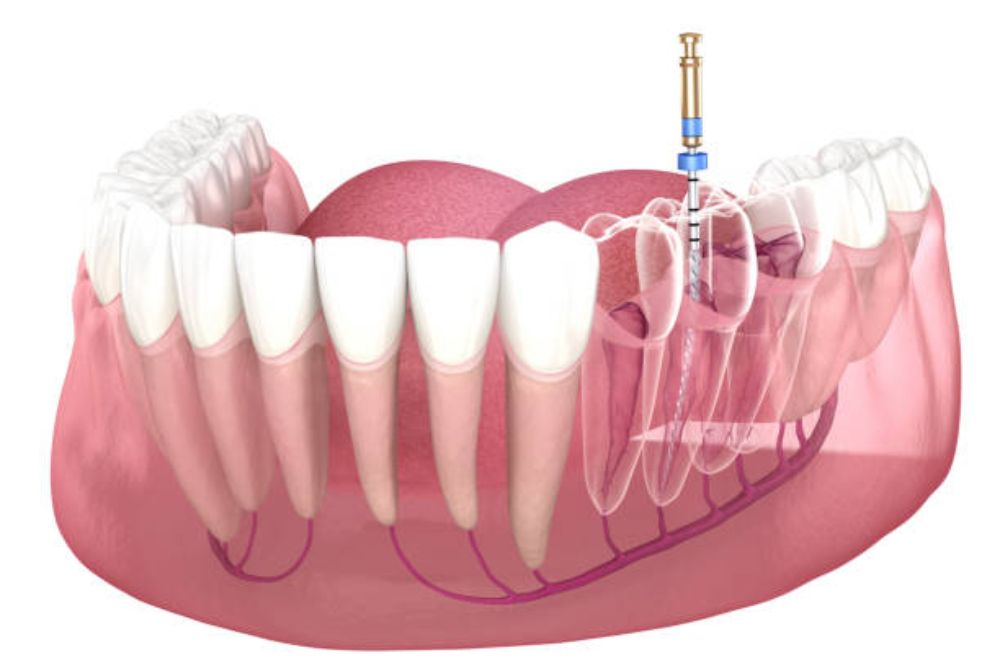 root canal therapy in Pitt Meadows